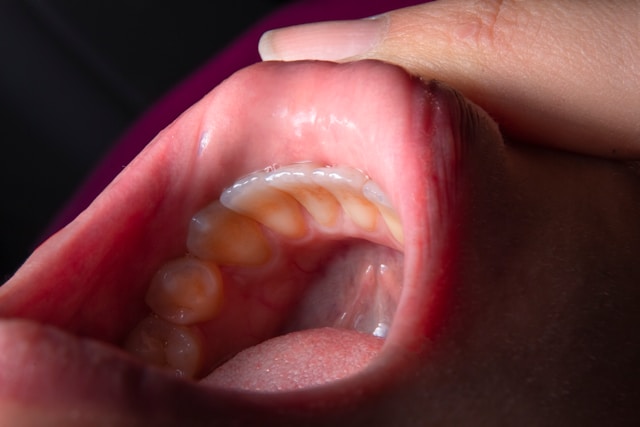 11 Causes of a Bump on the Roof of the Mouth That Isn't Painful